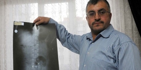 Sırtına isabet eden mermiyle 20 yıldır yaşıyor
